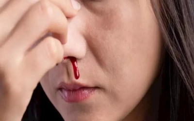 هل يسبب نقص الفيتامينات نزيف الأنف أو الفم؟