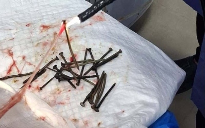 أطباء في مصر ينجحون في استخراج 100 مسمار من معدة مريض دون جراحة