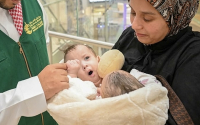 الرياض تفصل توأماً مغربياً ملتصقاً في عملية يشارك فيها 23 مختصاً